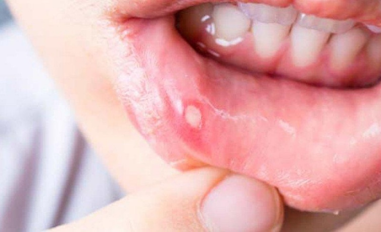 Ağız içinde yara ve uzunluğunda ele gelen şişlik kanser habercisi olabilir!