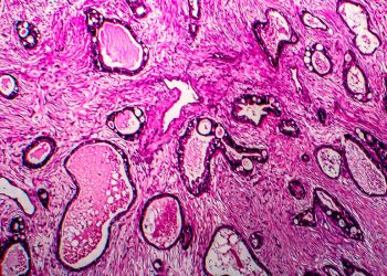 Saç Düzleştiriciler Rahim Kanseri İçin Küçük Bir Risk oluşturulabilir, Çalışma Araştırması