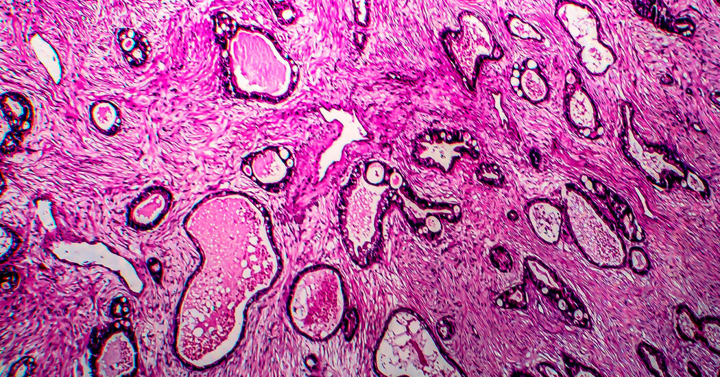Saç Düzleştiriciler Rahim Kanseri İçin Küçük Bir Risk oluşturulabilir, Çalışma Araştırması