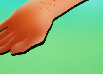 Yürüttüğünde Kan ve Garip Bir Döküntü Vardı.  Neyin var?