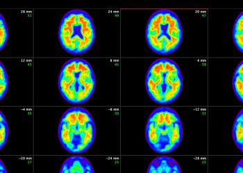 Alzheimer’ı Çok Erken Tedavi Etmek Düşüşü Yavaşlatmak İçin Daha İyi Bir Umut Sağlıyor, Çalışma Bulguları