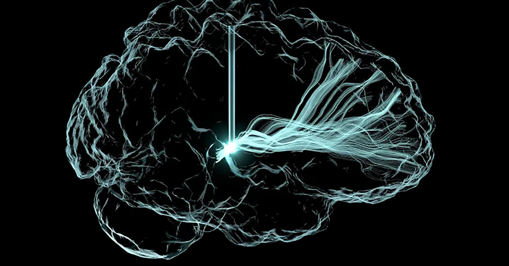 Beyin İmplantları Travmatik Yaralanmalardan Sonra 5 Kişinin İyileşmesine Yardımcı Oldu