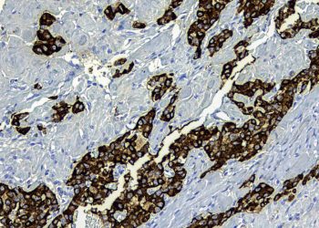 Pankreas Kanserindeki Artış Göründüğünden Daha Az Endişe Verici Olabilir