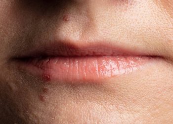 Daima Uçuk Çukariyorsanez Sebebi Bu Olabilir!