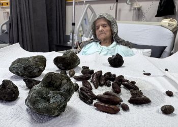 Zonguldak’ta 92 yaşındaki bayanın midesinden zeytin çekirdekleri çıktı