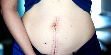 Asli-Bekiroglu8217ndan-5.-Ameliyat-Sonrasi-Moral-Veren-Paylasim-featured